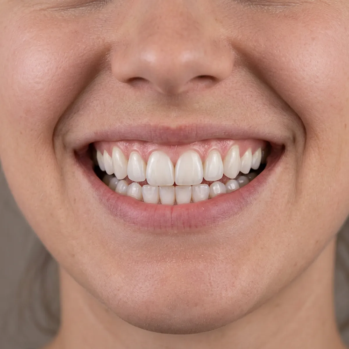Porcelain Veneers