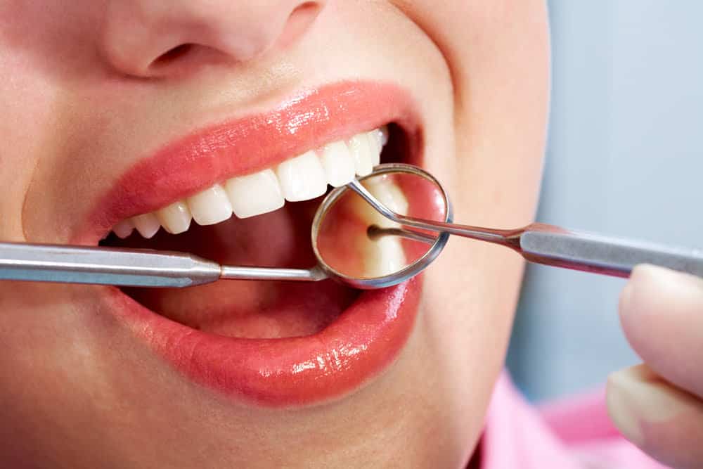 TEETH CLEANING | Algodones Dentists Guide