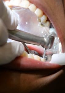 Dental Crowns