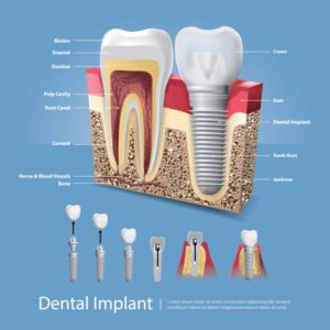 Dental implants