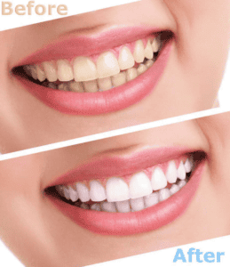 How to have perfect white teeth