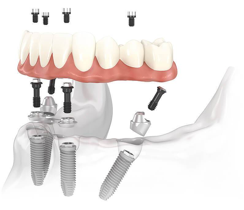 All-on-Four dental implant diagram for Los Algodones Dentists Guide