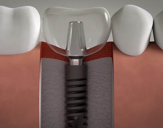Close-up illustration of dental implant components from a dentists in los algodones