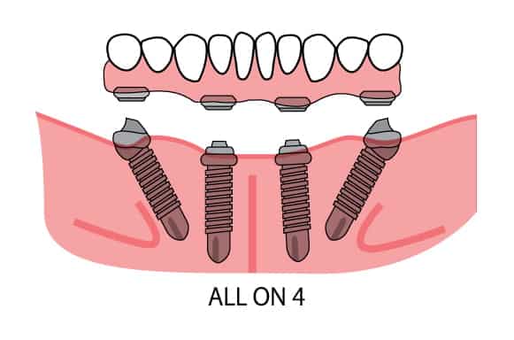 snap in dentures vs all on 4