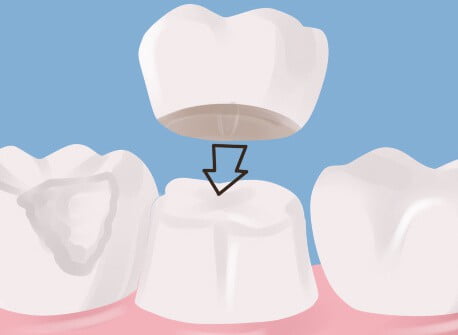 Dental crown placement illustration