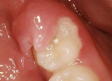 The Single Strategy To Use For Wisdom Teeth Removal Infection