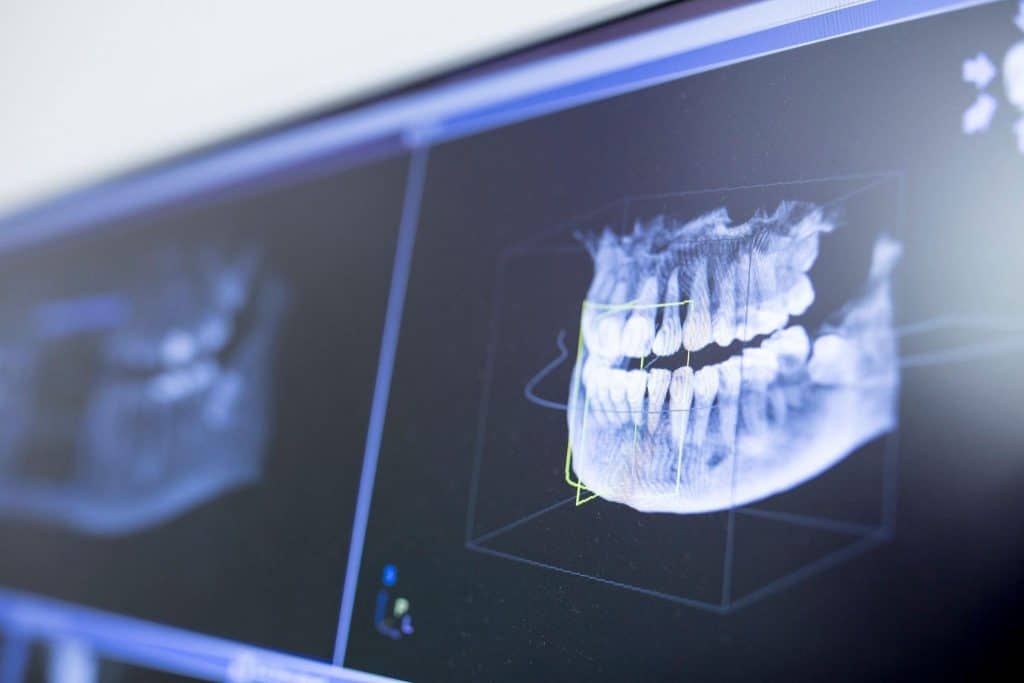 Close-up of a dental X-ray on a monitor, showcasing detailed tooth imaging 