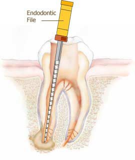 Illustration of a root canal procedure using an endodontic file at Los Algodones Dentists Guide